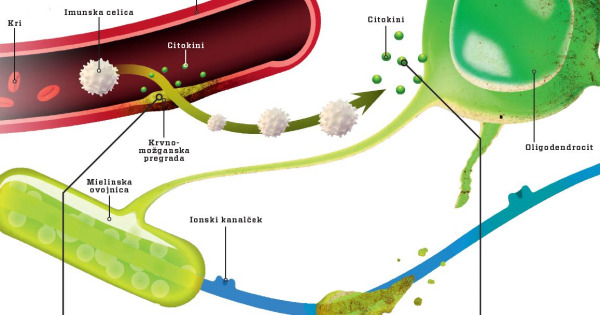 Iz slovenske izdaje revije Science Illustrated: Matične celice proti multipli sklerozi